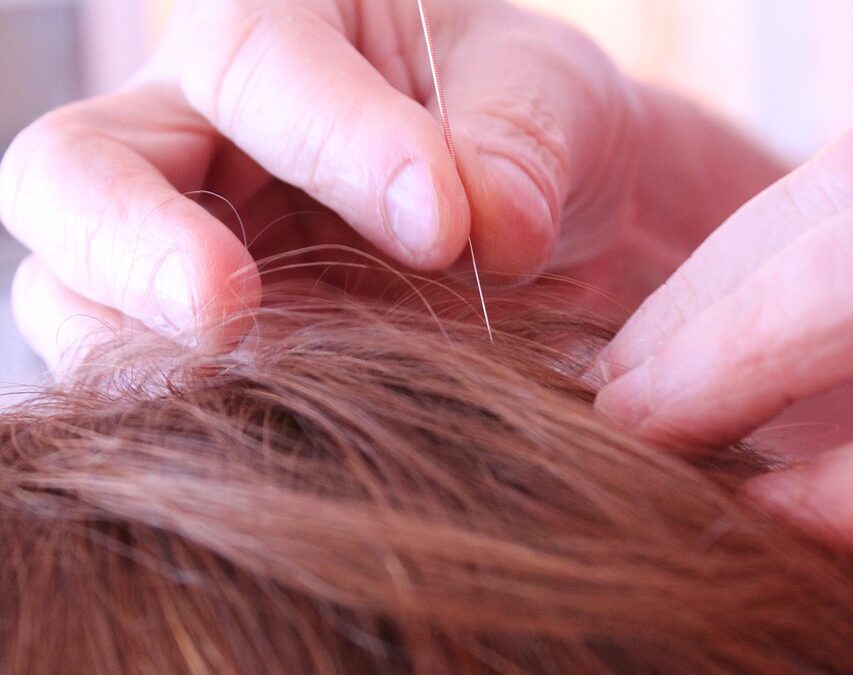 Unlocking Allergy Relief: The Ancient Art of Acupuncture